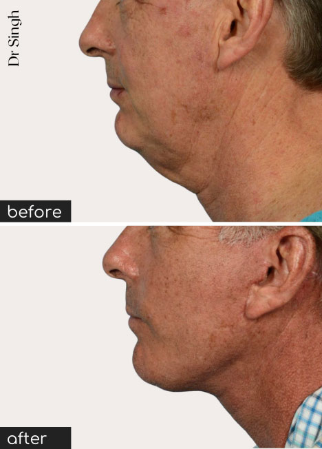 before after neck lift nyc